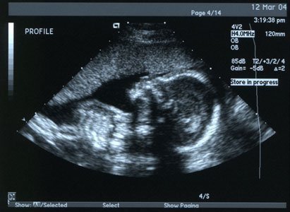 How Ultrasound Works