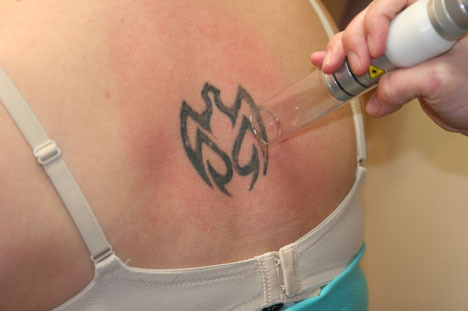 Laser Tattoo Removal How Laser Tattoo Removal Works