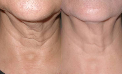 How a Laser Skin Tightening Works